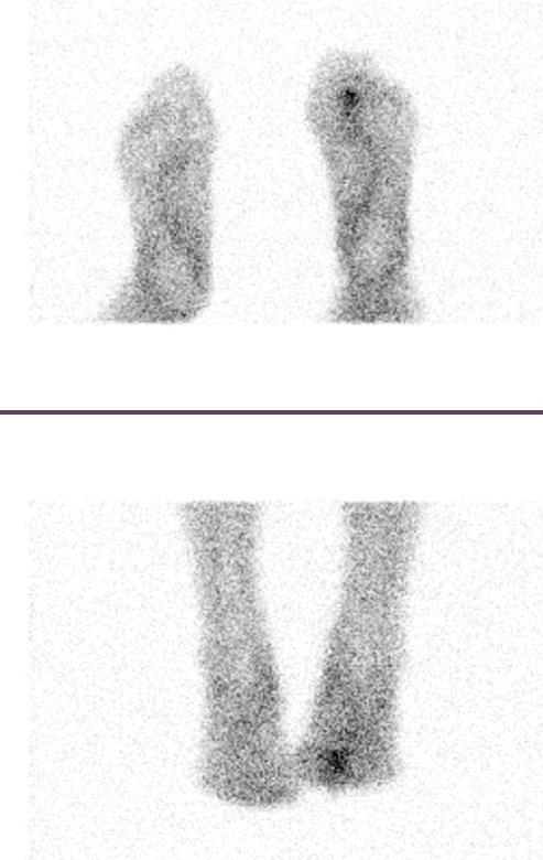 SPECT / CT