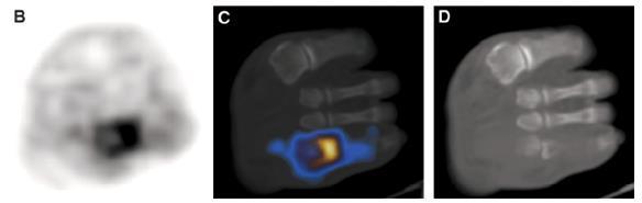 Απεικόνιση διαβητικού ποδιού 18 F-FDG PET/ CT ΟM