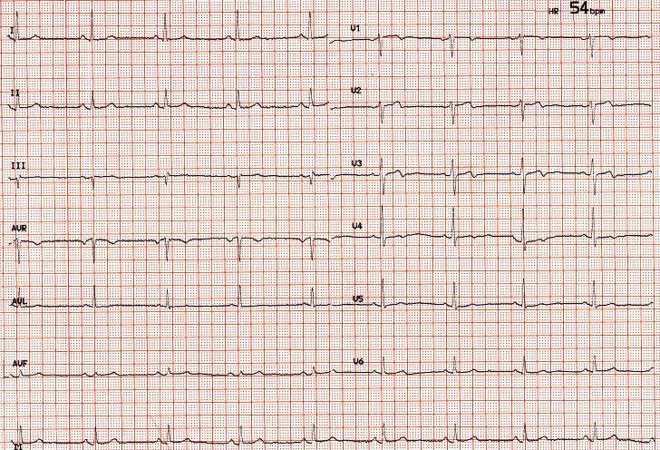ΗΚΓράφημα την επομένη το πρωί Wellens Syndrome*