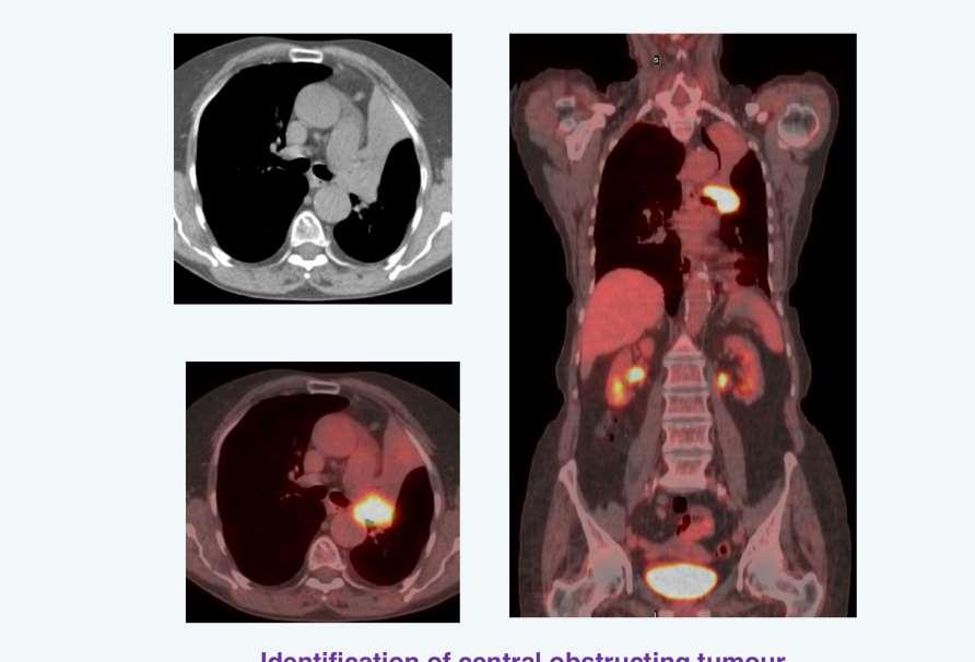 Ο ρόλος της PET/CT