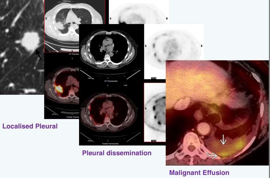 Ο ρόλος της PET/CT