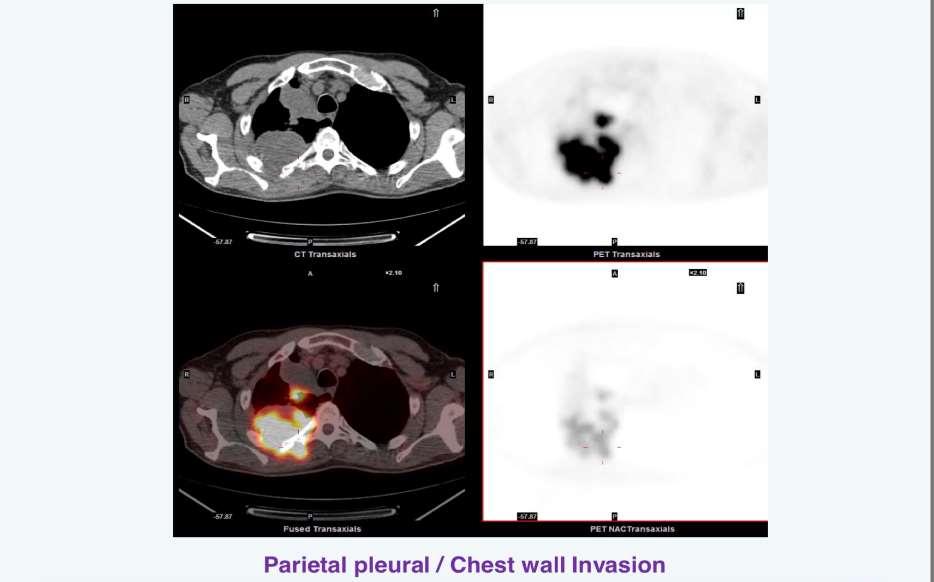 Ο ρόλος της PET/CT