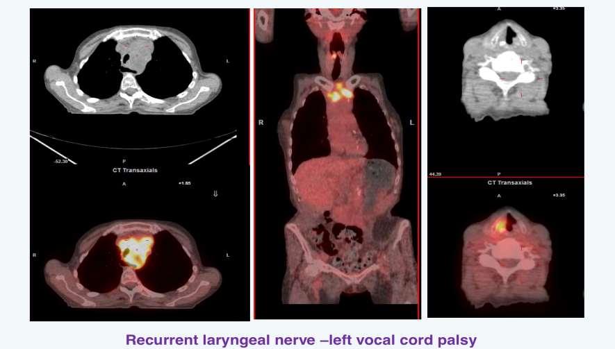 Ο ρόλος της PET/CT