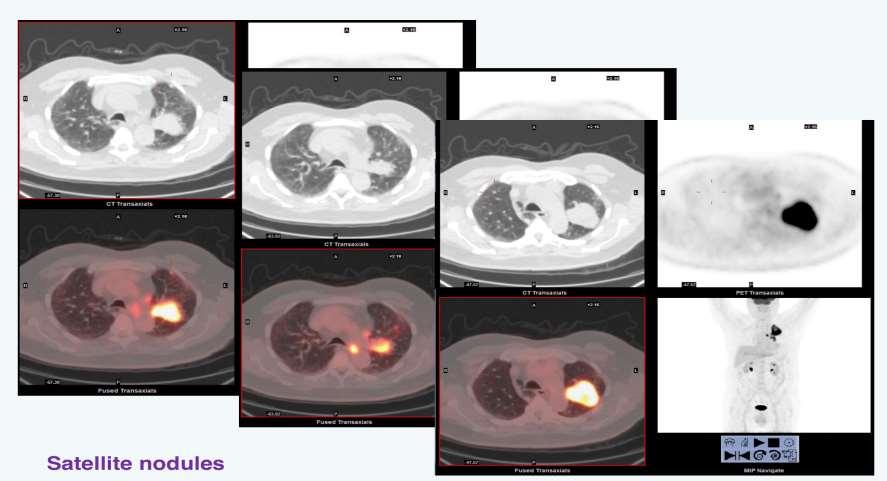 Ο ρόλος της PET/CT