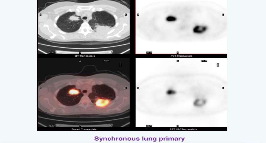 Ο ρόλος της PET/CT