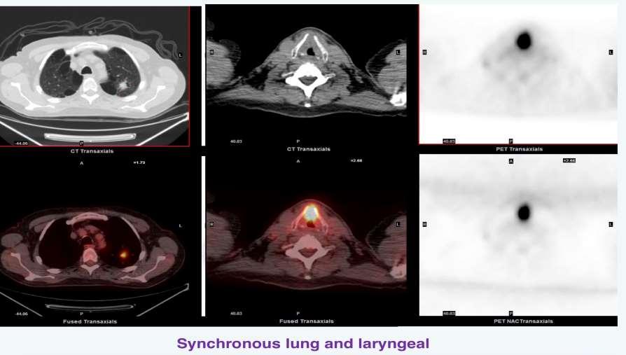 Ο ρόλος της PET/CT