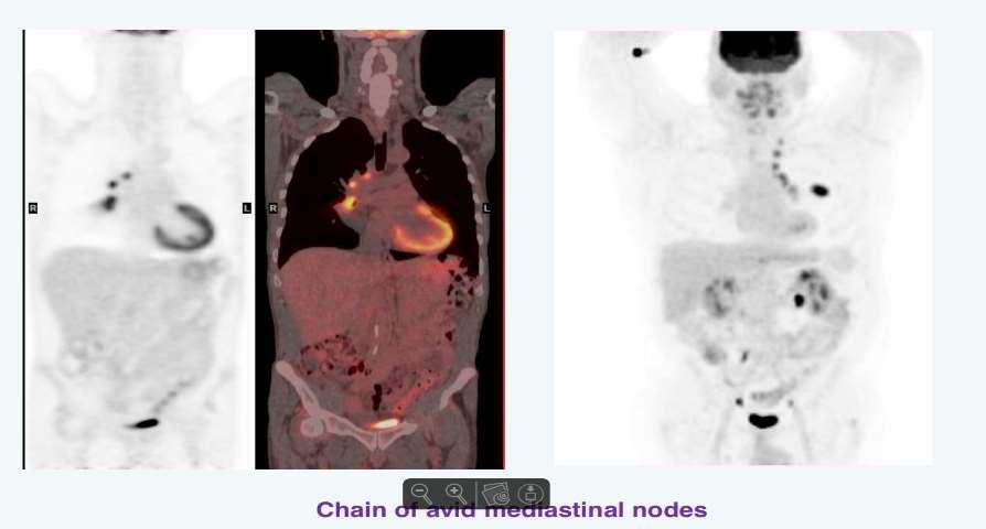 Ο ρόλος της PET/CT