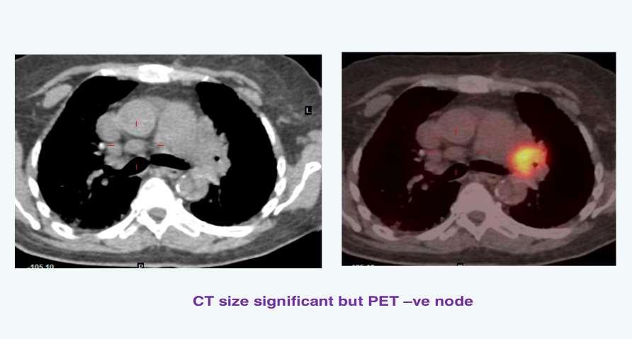 Ο ρόλος της PET/CT