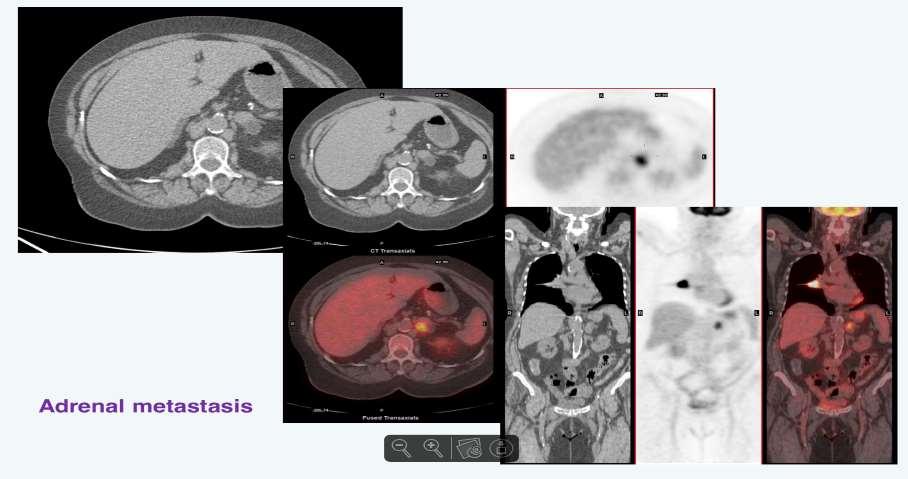 Ο ρόλος της PET/CT