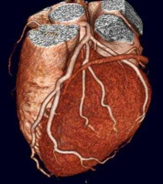 Το δίλημμα: CCTA ή Stress ECHO?