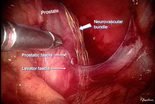 The incredible nerve-sparing surgery
