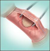 Peyronie s disease: grafting procedures are not friendly to erectile function 58.1% reported preoperative ED (vascular disease in 76.8%) (Kadioglu et al. 2011).