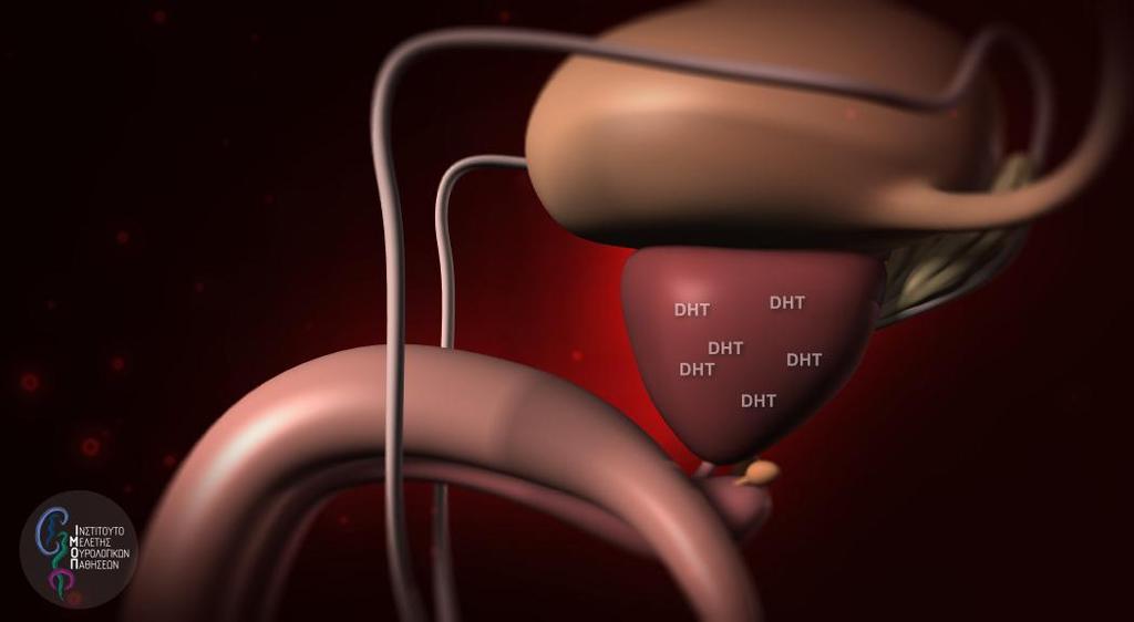 BPH-therapies and ED Clinical trials with 5ARI report prevalence rates of de novo erectile dysfunction of 5-9%, while decreased circulating dihydrotestosterone (DHT) in