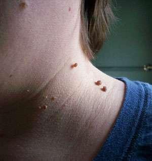 HPV ινίκσμε ζε παηδηά Δεξκαηηθά