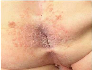 HPV ινίκσμε ζε παηδηά Πξσθηνγελλεηηθά θνλδπιώκαηα εμνπαιηθή θαθνπνίεζε