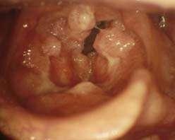 HPV ινίκσμε ζε παηδηά