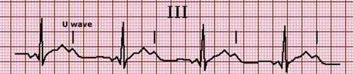 Υποκαλιαιμία ΗΚΓ αλλοιώσεις <3,5 meq/l