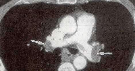 ΠΝΕΥΜΟΝΙΚΗ ΕΜΒΟΛΗ ιάγνωση Αξονική τοµογραφία θώρακος (spiral volumetric CT/ SVCT) Συσχέτιση µε αγγειογραφία : ευαισθησία