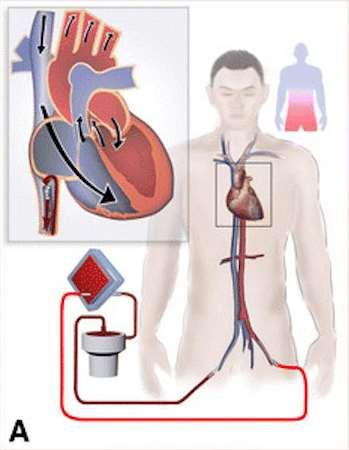 ECMO/ECLS Extra Corporal Membrane Oxygenation = Extra Corporal Life Support Προσωρινή εξωσωματική υποστήριξη