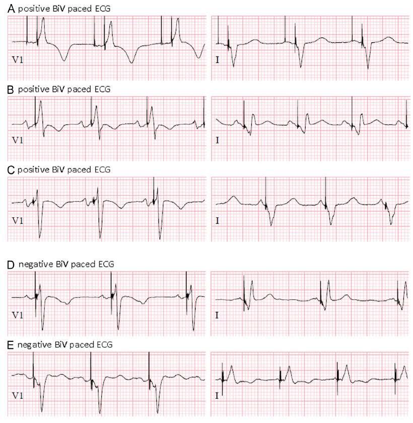 Of 68 patients, 49 (72%) met our BiV paced QRS