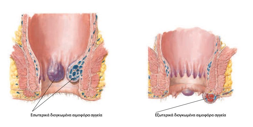 ΕΙΚΟΝΕΣ Οι αιμορροΐδες (φλεγμονή αιμοφόρων αγγείων) μπορεί να είναι