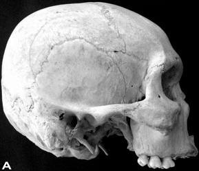 Murphy (1956) described 4