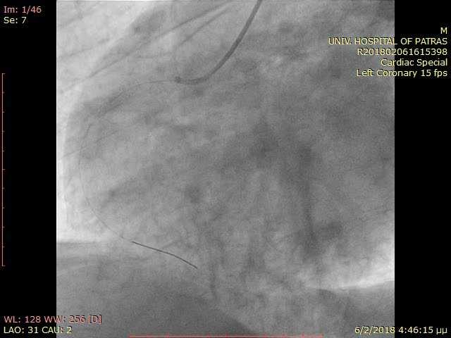 C/ANG-2 (STEMI