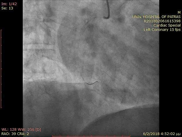 C/ANG-2 (STEMI