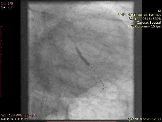 C/ANG-2 (STEMI LW) PCI