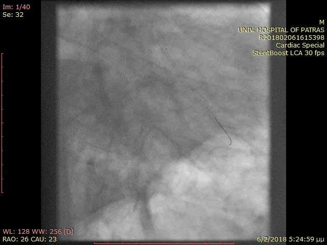 LW) PCI