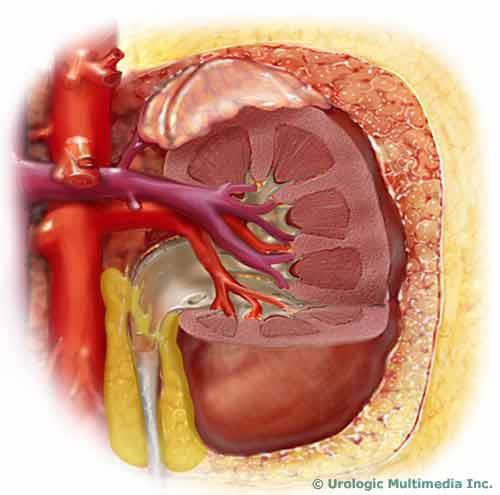 PERI-HEPATIC URINOMA A CASE REPORT Ir. Christodoulou, Z.Koukouritaki, C.Pogonidis, E.Xenodoxidou,M.Handolias, A.Amanatidou, C.Christianopoulos.