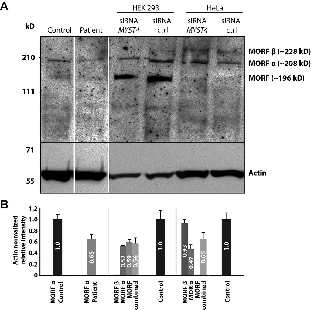 Supplemental Figure 1 Western blot analysis of MYST4. (A) Lymphoblastoid cell lines of the patient and a normal control in the first 2 lanes presenting mainly the MORF α isoform.