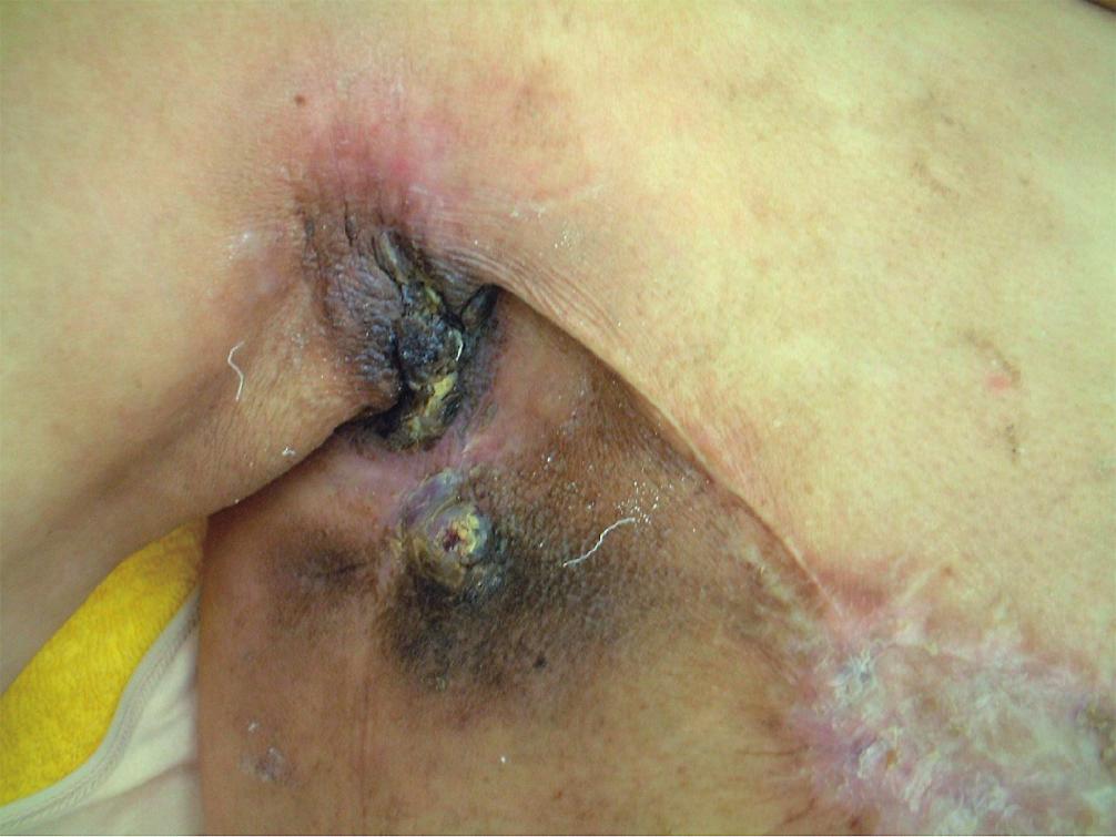 recurrent breast cancer. Am J Clin Oncol 24: 185191.
