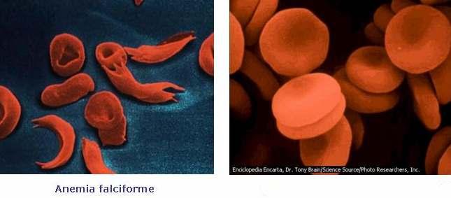 Un caso de mutación xénica: a anemia falciforme ou drepanocitose Glóbulos vermellos normais A anemia falciforme débese á presencia nas persoas que a padecen dunha forma de