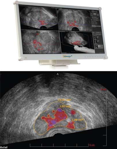 statos kotūrus visuose pasirinktuose 3 dimensijų vaizduose, speciali kompiuterinė programa pradeda histoskenavimą, o po kelių minučių ekrane pasirodo visų 3 dimensijų ultragarsinai prostatos vaizdai,