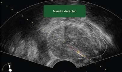 4 pav. Biopsinės adatos kelias į židinį Prostatos histoskenavimo vidutinė trukmė 30 minučių, kai po jos atliekama ir biopsija viskas užtrunka apie 1 valandą.