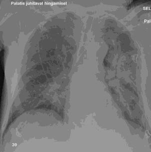 Mitteantibiootiline ravi pneumoonia korral Varane mobilisatsiooni kõikidel patsientidel: juba ravi algusest peale vähemalt 20 minutiks ööpäevas istuma/püsti Madalamolekulaarne hepariin ägeda