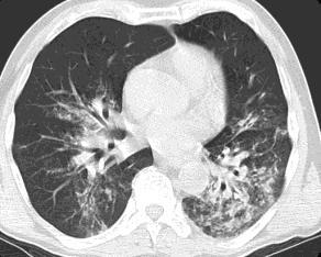 intensiivravi menetlused Glükokortikosteroidid ei ole pneumoonia korral näidustatud Köha - kaitserefleks Aspiratsioonipneumoonia: kellel kahtlustada Puudub definitiivne konsensus