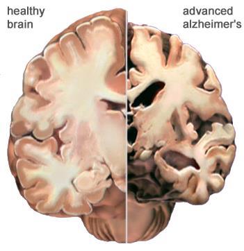 Alzheimer - What Happens? מבחינה מיקרוסקופית מחלת אלצהיימר מתאפיינת בשלושה ממצאים עיקריים: שקיעה בתוך המוח של חלבון המכונה עמילואיד.
