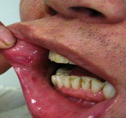 נושאי ההרצאה Oral Ulcerations ORALMEDIC HYALURONIC ACID Zinc B12 Diabetes Type 2 \ OC B12 B6 Alzheimer Gingko Biloba PS
