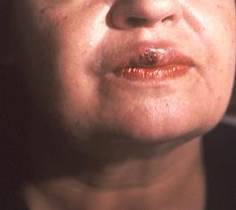 -Phytosterols 3 עידו שטרייכמן Oral Ulcerations כיב בפה הוא הפצע השכיח ביותר ברקמות רכות בפה.