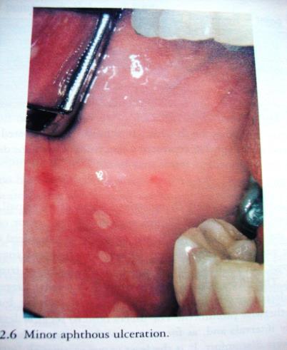 MINOR APHTHOUS ULCERATION 9 Typical features מתחיל בד"כ