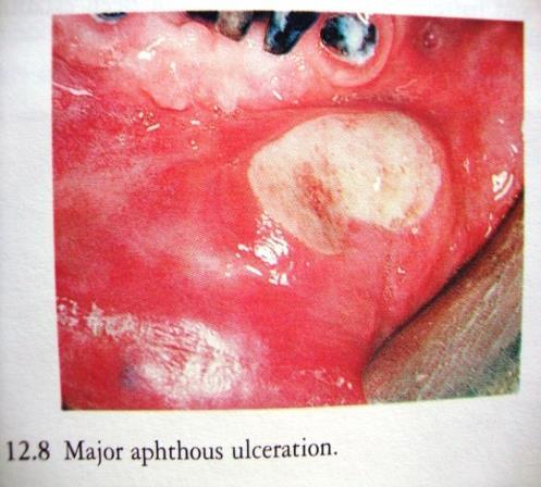 MAJOR APHTHOUS ULCERATION יכולים להופיע בכל מקום בחלל הפה כולל בשכבת הקראטין במוקזות הפה.