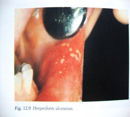 HERPTIFORM ULCERATION 13 הסממן הוא שמופיעות הרבה מאוד אפטות במקבצים.