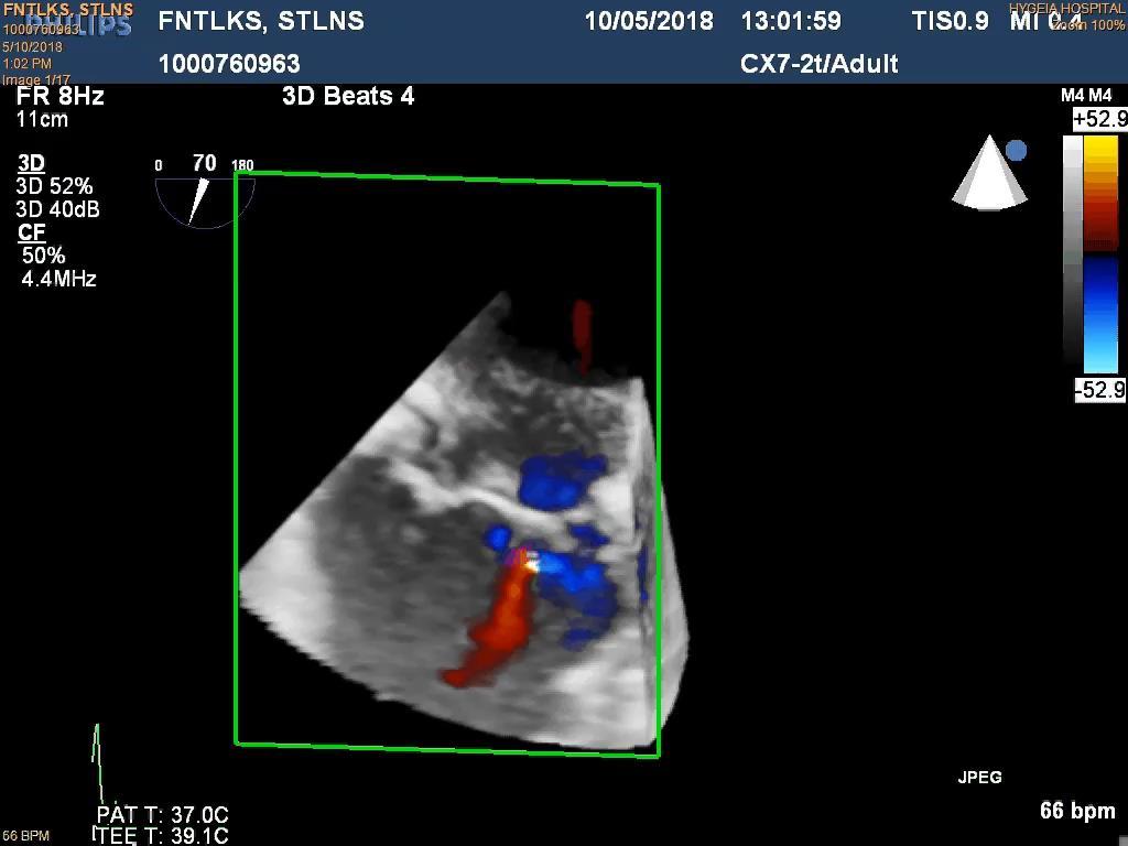 Mitral Valve after