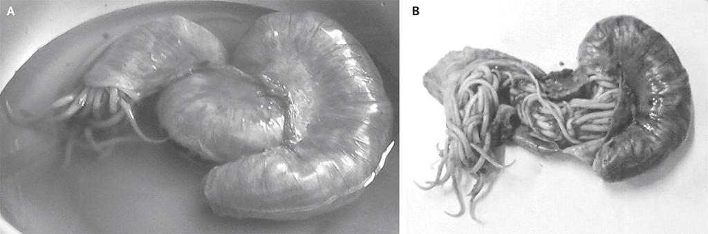Εικόνα 3: Απόφραξη ειλεού από Ascaris lumbricoides σε κορίτσι 10 ετών από την Κένυα. Πηγή: Mwenda AS, Ilkul JH.