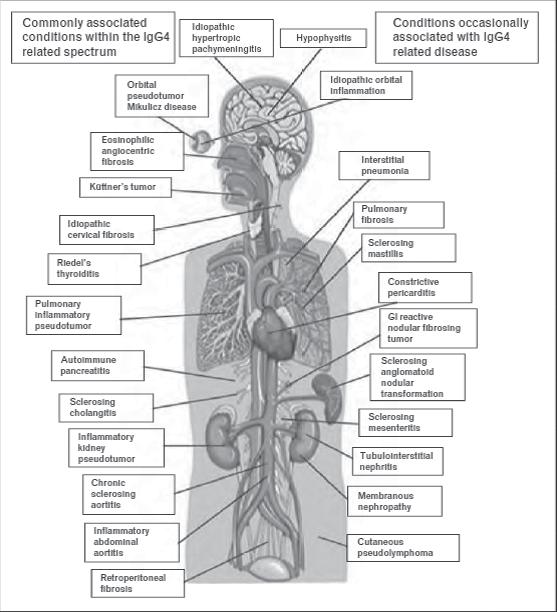 Εικόνα 1: Νόσος σχετιζόμενη με την IgG4 (IgG4-RD). Carruthers MN, Stone JH, Khosroshahi A, The latest on IgG4-RD: a rapidly emerging disease. Curr Opin Rheumatol.