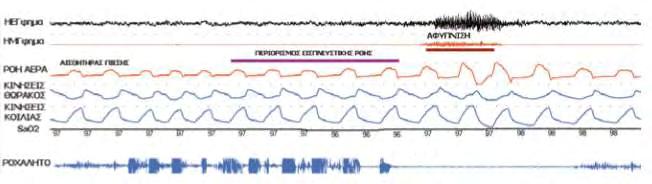 Δείκτης αναπνευστικής διατάραξης (RDI) Είναι το νούμερο των απνοιών, υποπνοιών και αναπνευστικής προσπάθειας σχετιζόμενο με τις αφυπνίσεις (REPAs) ανά ώρα ύπνου, επιβεβαιωμένο από EEG Σύνδρομο