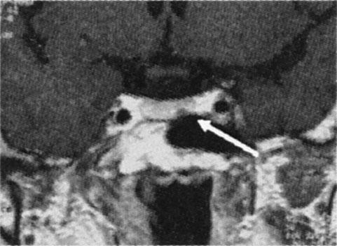 Subclinical Cushing 2 1 Table 2 LH FSH GH PRL TSH FT 3 FT 4 ACTH Cortisol 18.2 miu ml 65.4 miu ml 1.63 ng ml 28.7 ng ml 0.22 µ IU ml 2.2 pg ml 0.9 ng dl 19 pg ml 18.1 µ g dl 7.5 56.2 9.2 124.7 0.0 3.