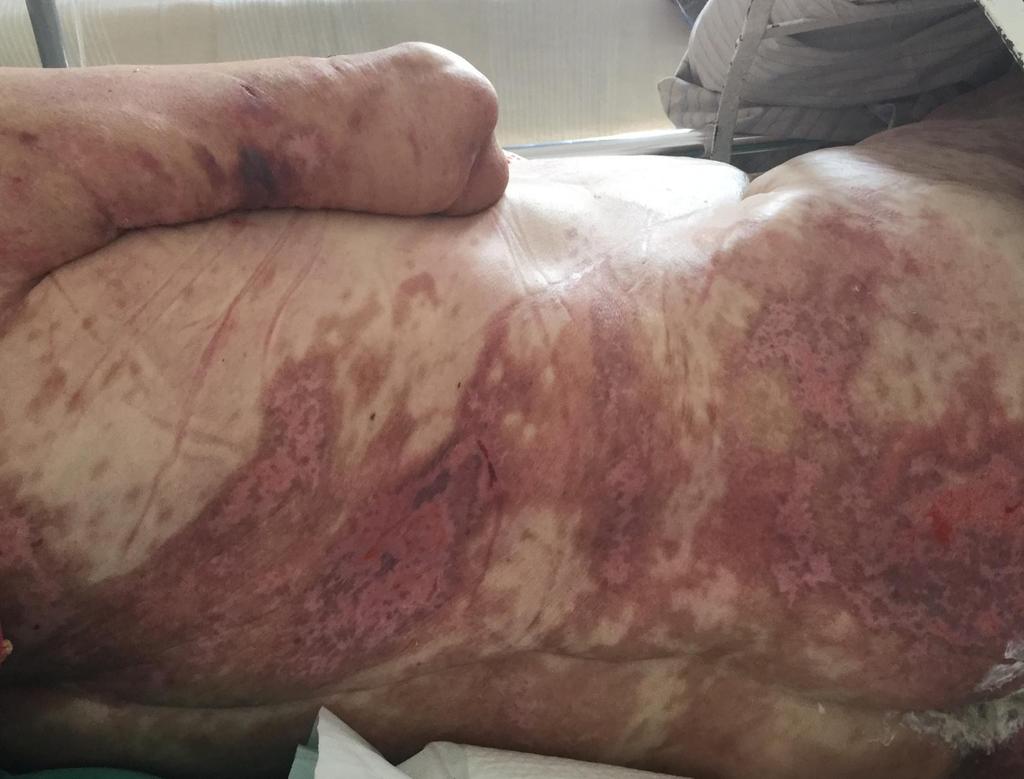 Βακτηριαιμία από πολυανθεκτικό μικρόβιο τροποποίηση αντιβιοτικής αγωγής Υψηλές δόσεις κορτικοστεροειδών